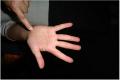 It turns out playing in a samba band isn't as easy as it looks- blisters on Melissa's hand